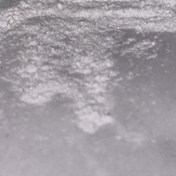 Adipo Plus Exterme İlacı Üç Gün Hastanede Kalarak Serum Tedavisi Gördüm