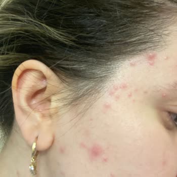 Loreal Paris Fondöten Sivilce Yapıyor Cildi Çok Kötü Yapıyor