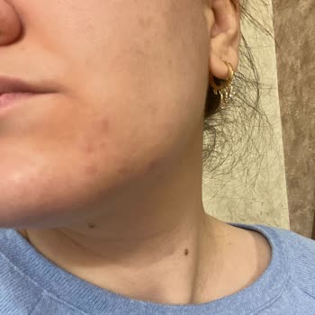 Loreal Paris Fondöten Sivilce Yapıyor Cildi Çok Kötü Yapıyor