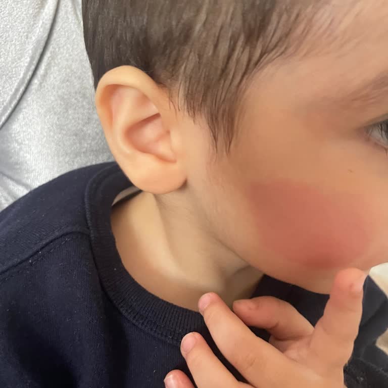 Mustela Gel Arnica " Kızarıklık Oluştu "