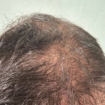 Adana Saç Ekimi Ve Estetik Merkezi Yaşadığım Mağduriyet Ve Yetersiz Hizmet