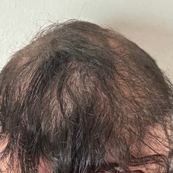 Adana Saç Ekimi Ve Estetik Merkezi Yaşadığım Mağduriyet Ve Yetersiz Hizmet