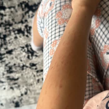 İstanbul Aydın Üniversitesi VM Medical Park Hastanesi Lazer Epilasyon Sonrası Yanık İzi