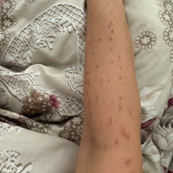 İstanbul Aydın Üniversitesi VM Medical Park Hastanesi Lazer Epilasyon Sonrası Yanık İzi