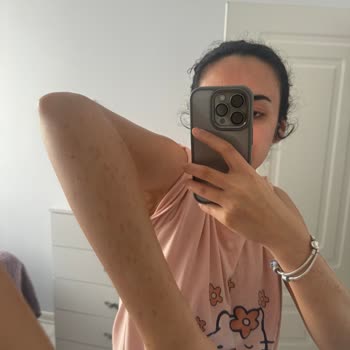 İstanbul Aydın Üniversitesi VM Medical Park Hastanesi Lazer Epilasyon Sonrası Yanık İzi