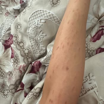 İstanbul Aydın Üniversitesi VM Medical Park Hastanesi Lazer Epilasyon Sonrası Yanık İzi