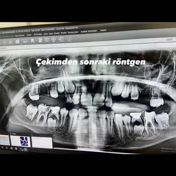 Medipol Sağlık Grubu Kalıcı Diş Çekimi