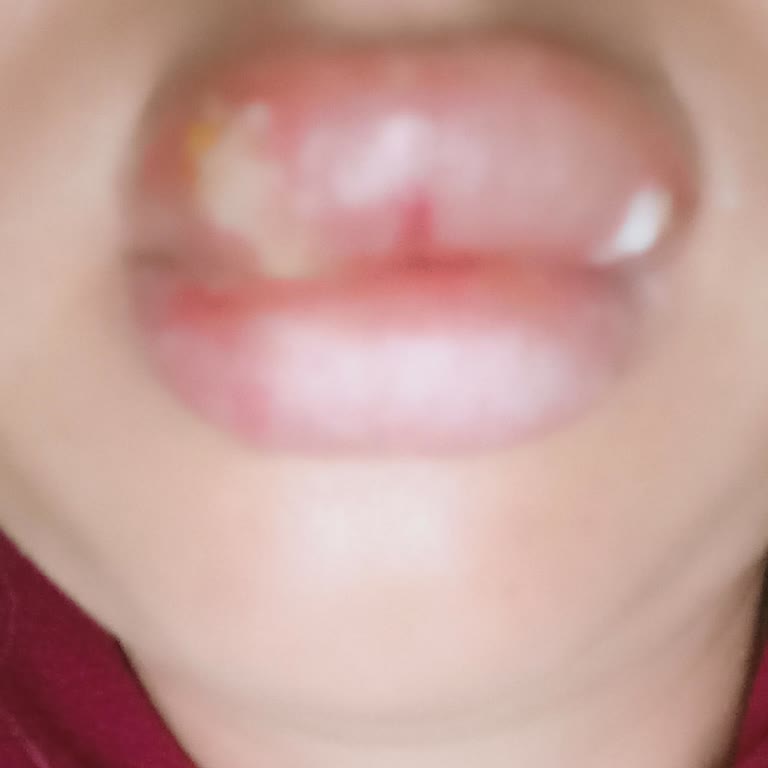 British Esthetic Dudak Dolgusu Sonrası Beklenmedik Tepki Ve Randevu Sorunu