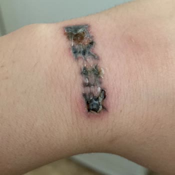 Asuman Çil Dövme Silme Şikayeti!