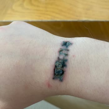 Asuman Çil Dövme Silme Şikayeti!