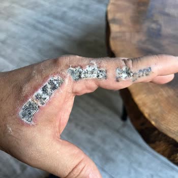 Asuman Çil Dövme Silme Şikayeti!