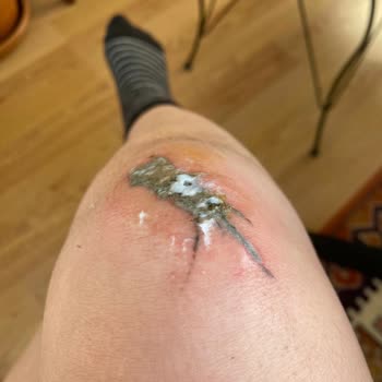 Asuman Çil Dövme Silme Şikayeti!