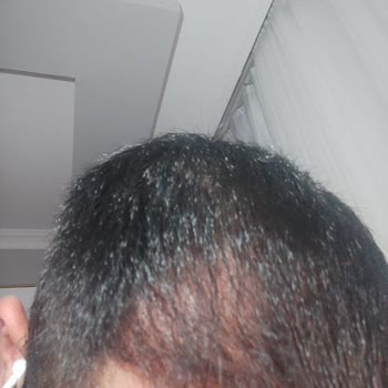 Rst Aesthetic Başarısız Sonuçlanan Saç Ekimim