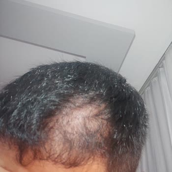 Rst Aesthetic Başarısız Sonuçlanan Saç Ekimim