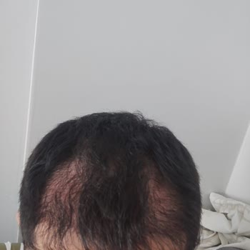 Rst Aesthetic Başarısız Sonuçlanan Saç Ekimim