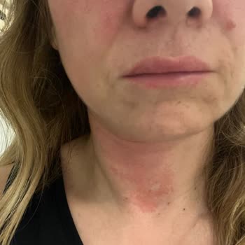 Rossmann Altera C Vitamini Kullanımı Sonrası Beklenmedik Kızarıklık