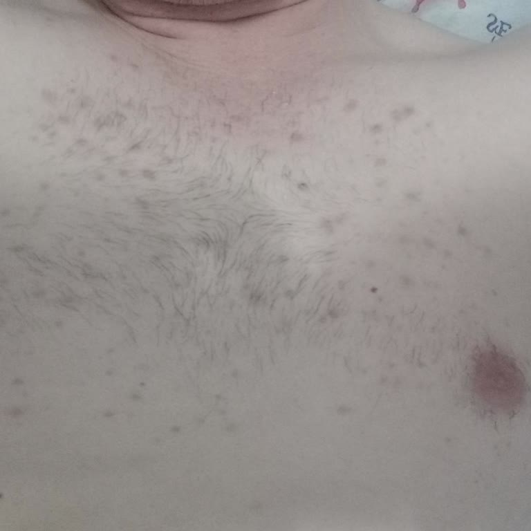 Veet Çok Tahriş Etti