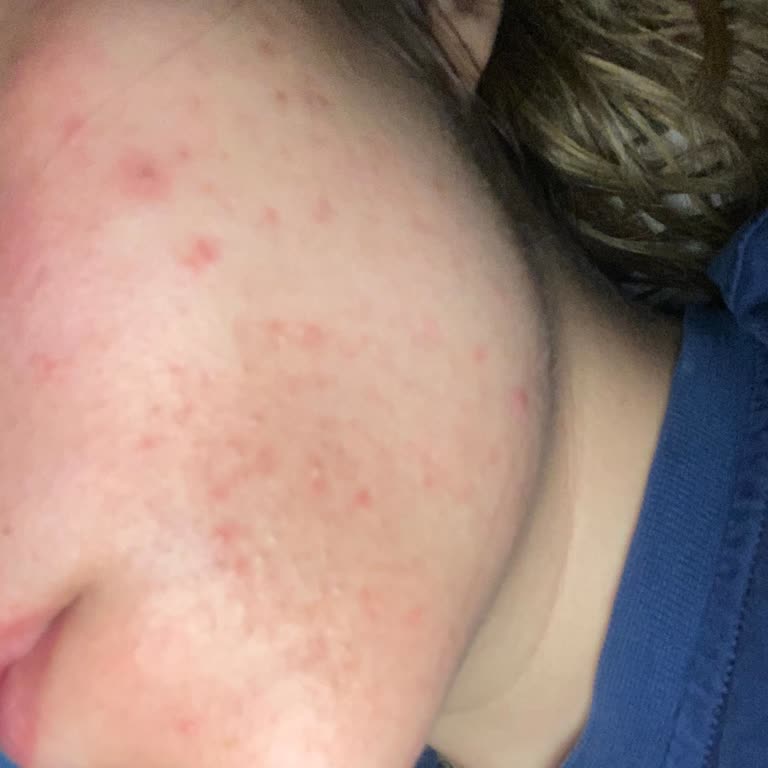 Maruderm Pürifying Jel Yüzümde Bir Sürü Sivilce Ve Kızarıklık Yaptı