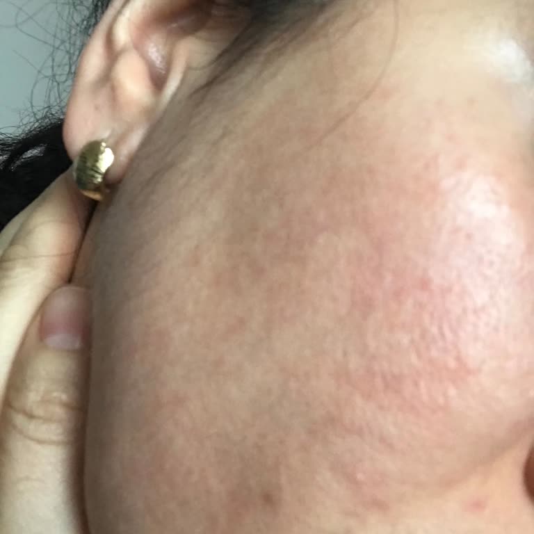 Bioderma Hydrabio Jel Krem Alerji Şikayeti