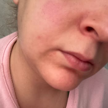 Maruderm Yüzümü Resmen Mahvetti