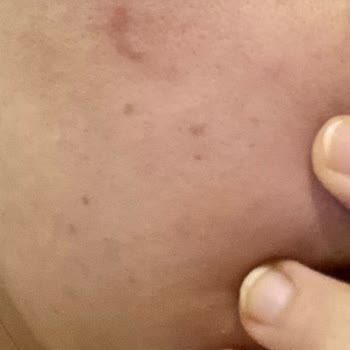 Mersin Selin Beauty Güzellik Merkezinde Lazer Yanığı