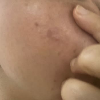 Mersin Selin Beauty Güzellik Merkezinde Lazer Yanığı