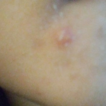 La Roche Posay Nemlendirici Sivilce Yaptı