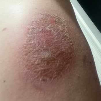 Zendora Deluxe Kristal Peeling Yanık