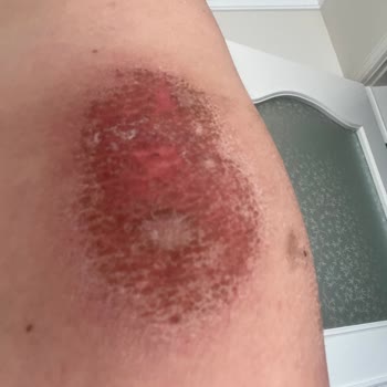 Zendora Deluxe Kristal Peeling Yanık