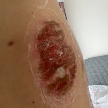 Zendora Deluxe Kristal Peeling Yanık