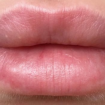 New Life Estetic Gayrettepe Nlife Clinic Mecidiyeköy Dolgu Faciası