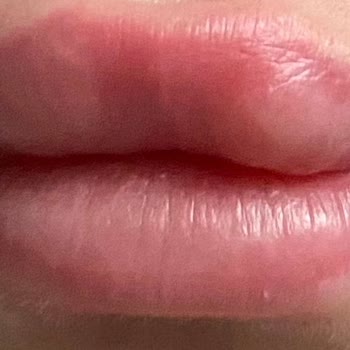 New Life Estetic Gayrettepe Nlife Clinic Mecidiyeköy Dolgu Faciası