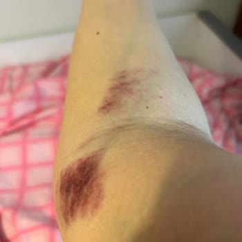 İstinye Üniversitesi Hastanesi Kolumun Haline Bakın