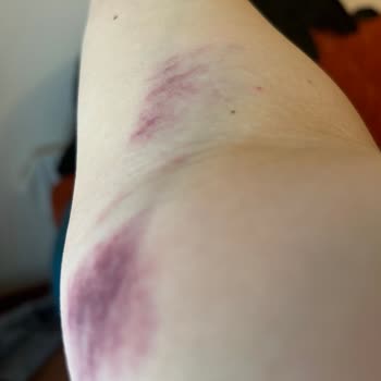 İstinye Üniversitesi Hastanesi Kolumun Haline Bakın