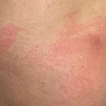 Gaziosmanpaşa Minty Güzellik Merkezi Lazer Epilasyon