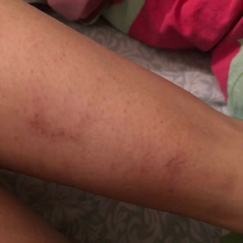 Gaziosmanpaşa Minty Güzellik Merkezi Lazer Epilasyon