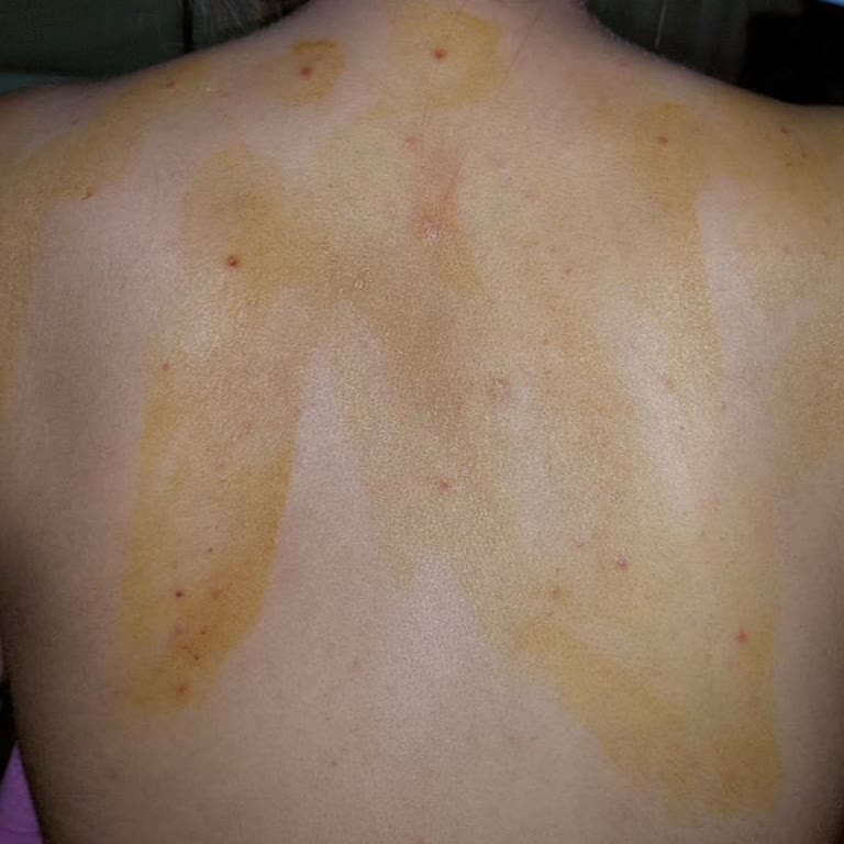 Novar Poliklinik Novar Alsancak Yüzünden Sırtım Yara Kaplı