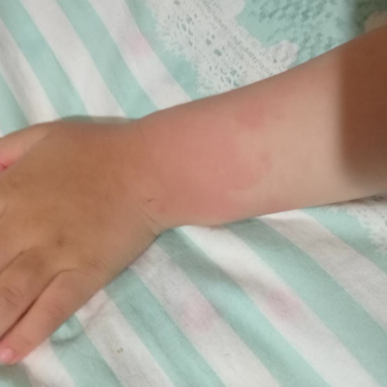 Bebem Natural Bebek Bezi Alerji Yapıyor!