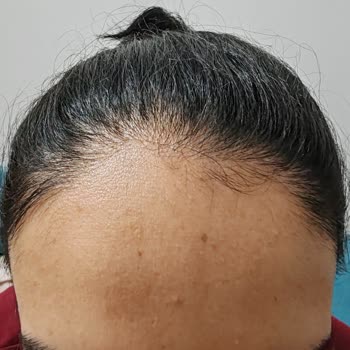 Novar Poliklinik Tüylerim İçin Gittim Saçımı Yok Ettiler.