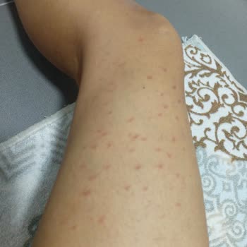 Novar Poliklinik Tüylerim İçin Gittim Saçımı Yok Ettiler.