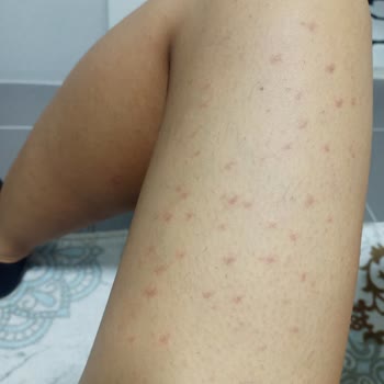 Novar Poliklinik Tüylerim İçin Gittim Saçımı Yok Ettiler.