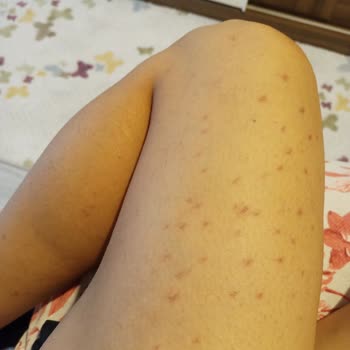 Novar Poliklinik Tüylerim İçin Gittim Saçımı Yok Ettiler.