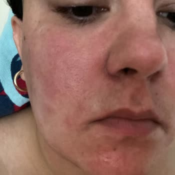 Maruderm Yüz Yıkama Jeli Yüzümü Mahvetti