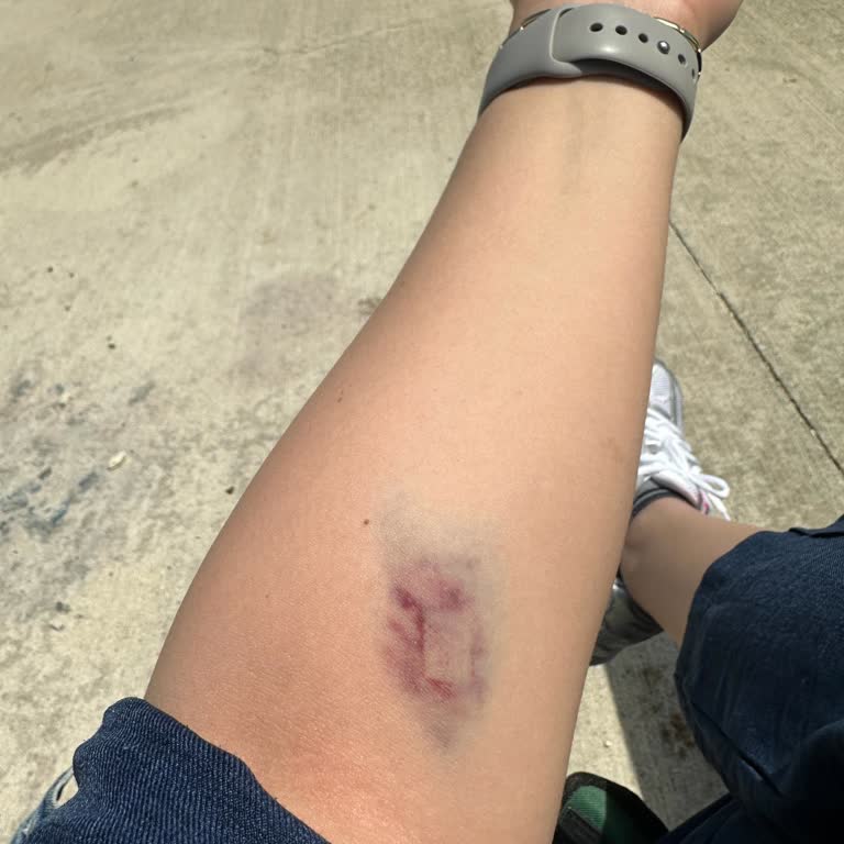 Kolan Hospital Silivri Hastanesi Damar Yolumu Patlattı