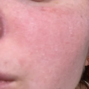 Avéne Cildimi Alerji Yaptı