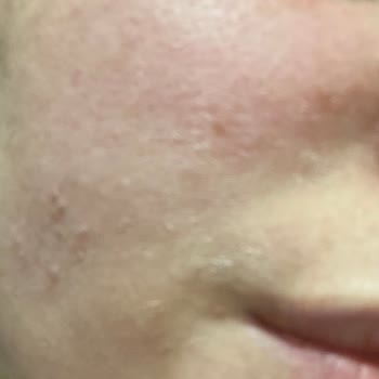 Avéne Cildimi Alerji Yaptı