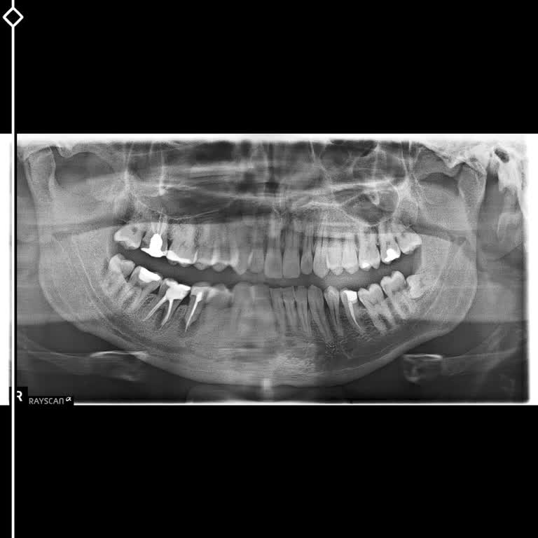Yeni Yüzyıl Üniversitesi Diş Hekimliği Fakültesi Hastanesi Yanlış İşlem Sebebi İle Diş Çekimi