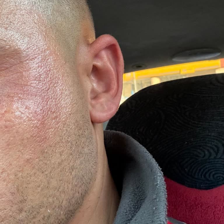 Loreal Gece Serumundan Kaynaklanan Cilt Reaksiyonu