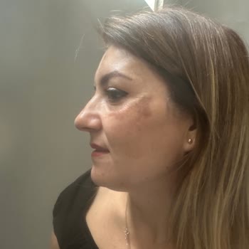 Sağlık Bakanlığı Hamilelik Sonrası Cilt Lekeleri Kabusa Dönüştü