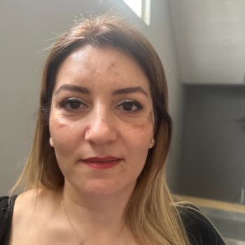 Sağlık Bakanlığı Hamilelik Sonrası Cilt Lekeleri Kabusa Dönüştü